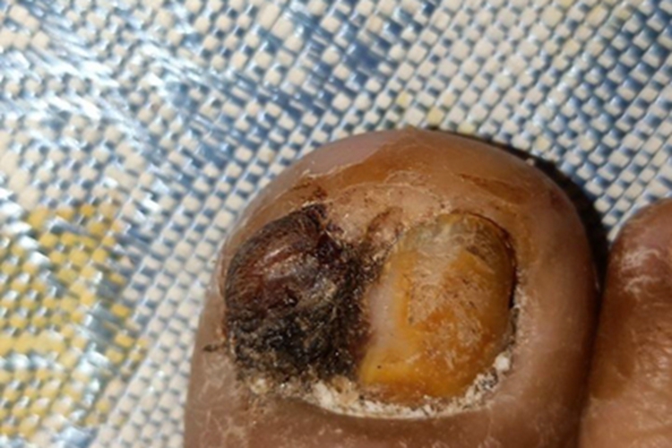 急性化脓性甲沟炎脚趾甲症状图