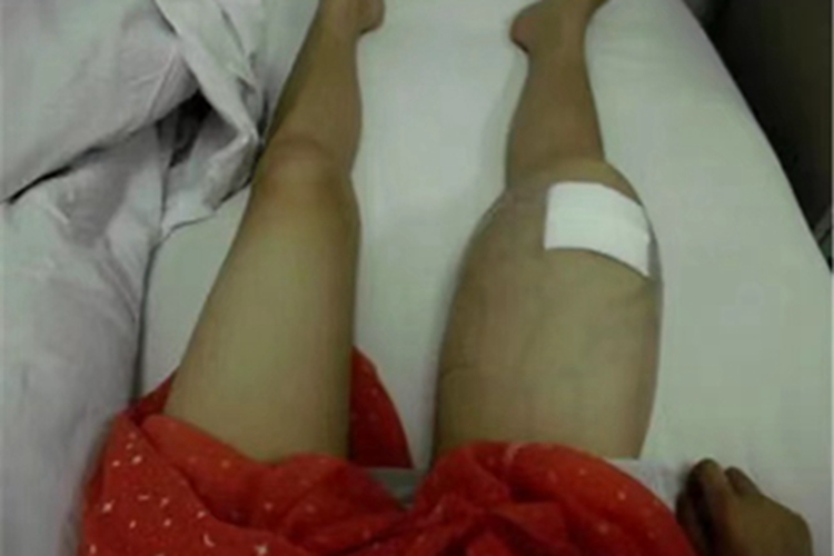 骨肉瘤大腿肿了一大圈图