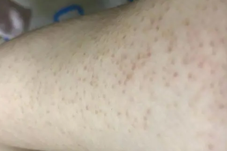 胳膊毛周角化症图