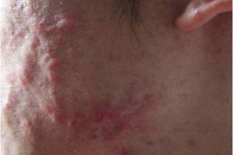 聚合性痤疮面部有凸起疙瘩图