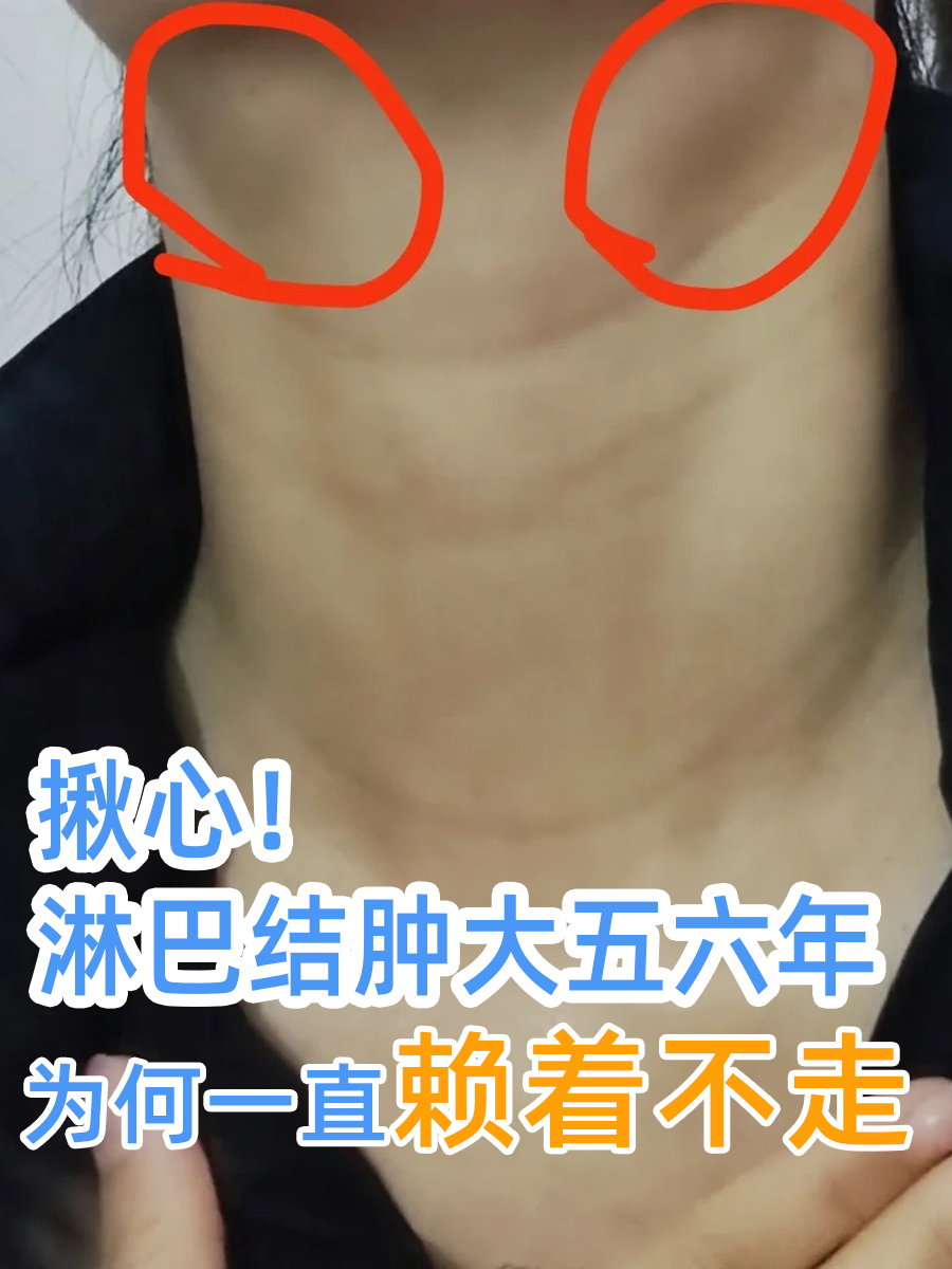 揪心!淋巴结肿大五六年,为何一直赖着不走