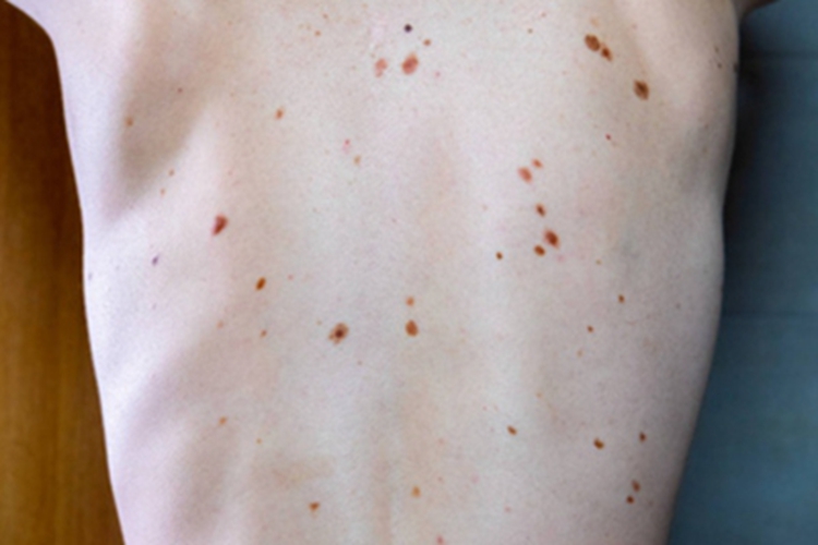 发育不良痣综合征皮肤长痣图