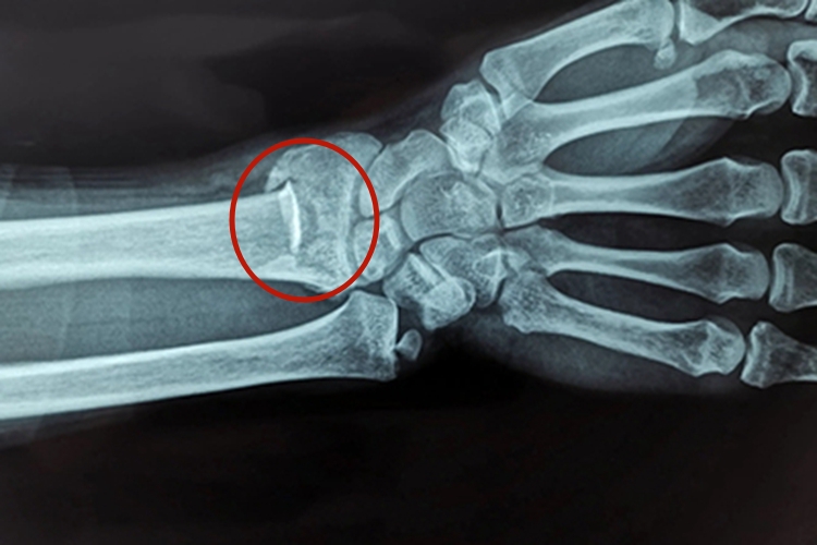 手腕桡骨远端骨折X线图