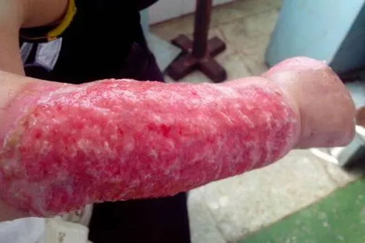 小孩开水烫伤三度图 小孩开水烫伤三度图