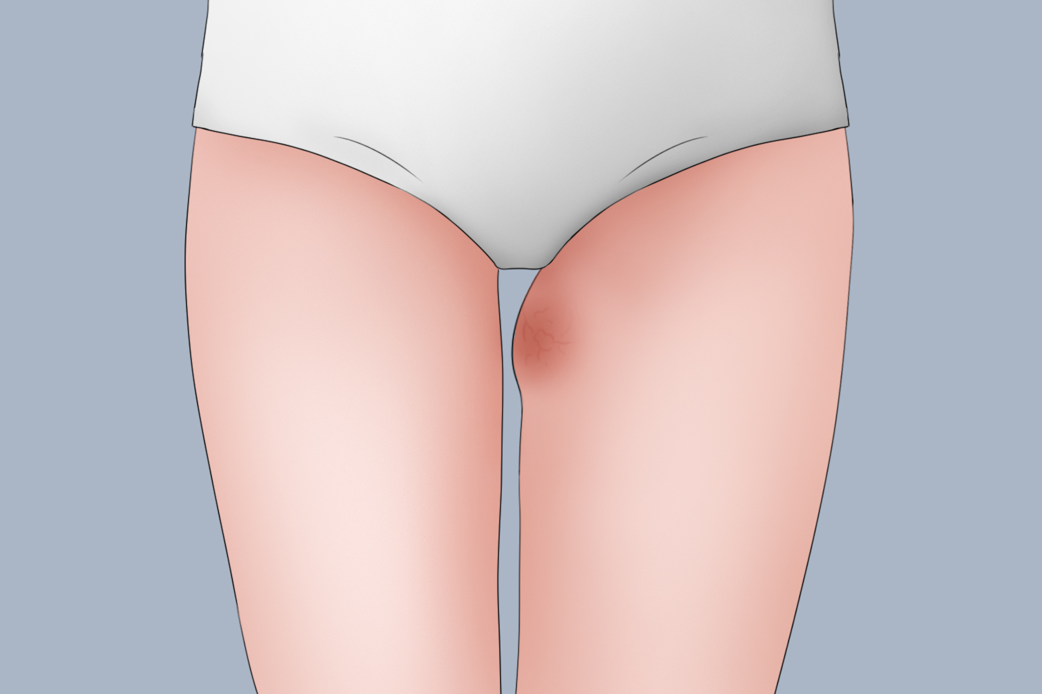 大腿根部脂肪肉图 大腿根部脂肪肉图