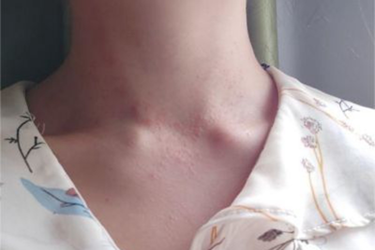 湿疹型多形性日光疹前颈症状图