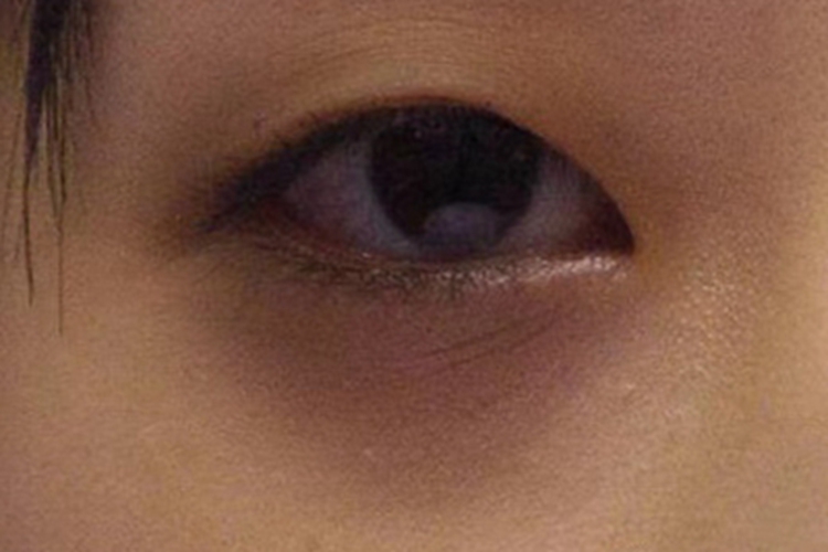 眶周色素沉着症眼睛下颜色暗图 眶周色素沉着症眼睛下颜色暗图