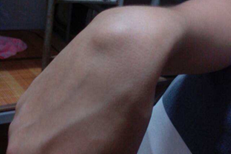 皮下脂肪瘤手背症状图