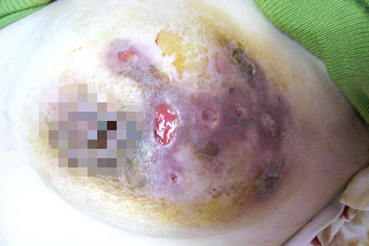 肉芽肿性乳腺炎图 肉芽肿性乳腺炎图