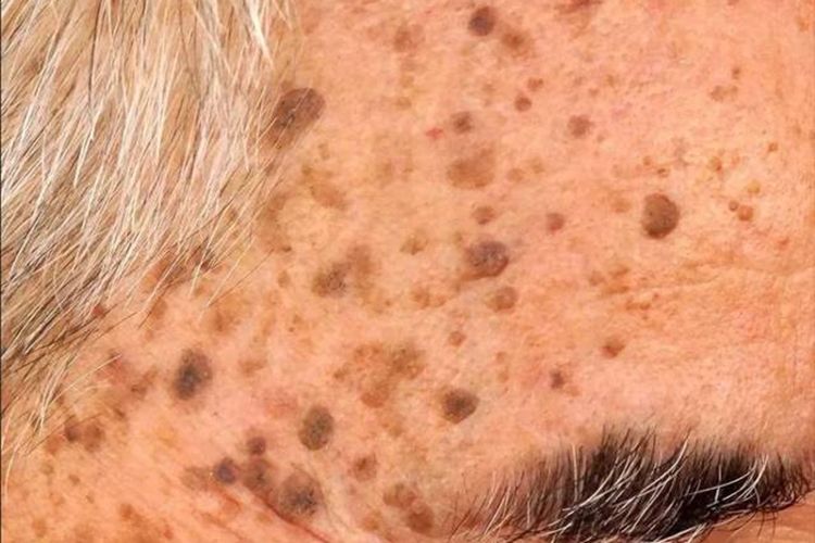 老年人脸上脂溢性角化病图