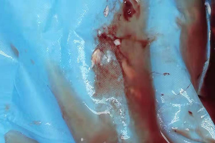 胎膜早破带有胎脂的液体图