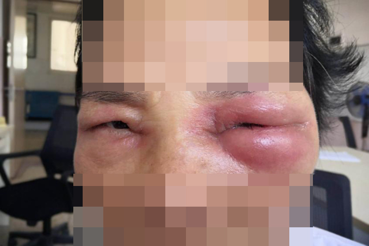 眼部急性蜂窝织炎图 眼部急性蜂窝织炎图