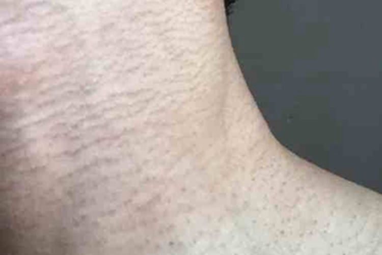 毛囊角化病颈部皮肤颜色加深图 毛囊角化病颈部皮肤颜色加深图