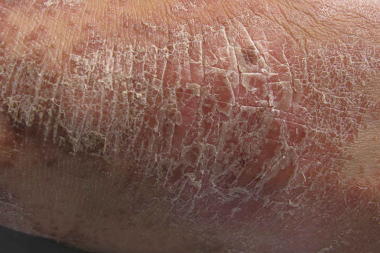 毛囊角化性丘疹图