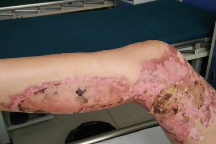 植皮术后淡黄色结痂图