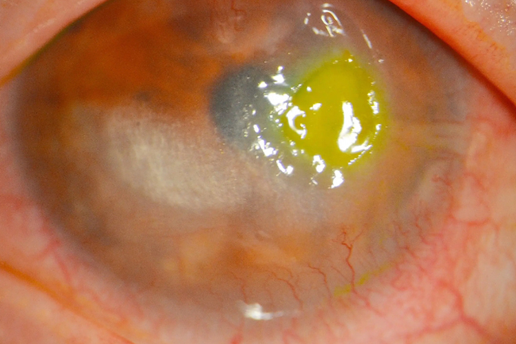 病毒性角膜炎经久不愈后形成地图状溃疡,常合并虹膜睫状体炎,但不伴前