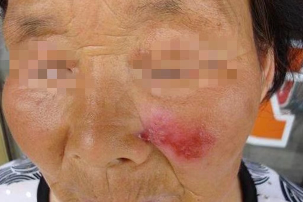 盘状红斑狼疮皮肤红块图