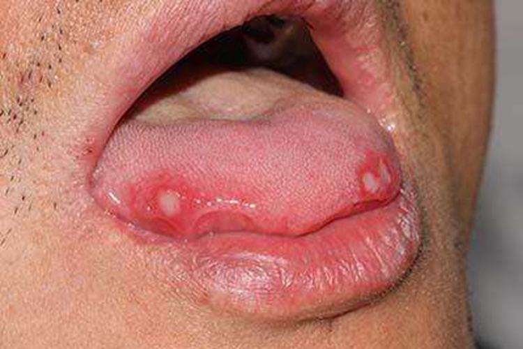 舌癌舌头上有多个溃疡图