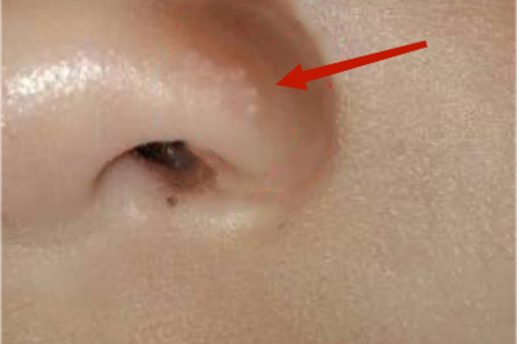 皮脂腺增生鼻翼症状图