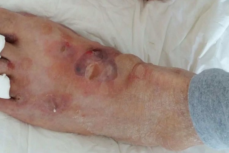 寻常型天疱疮脚部症状图