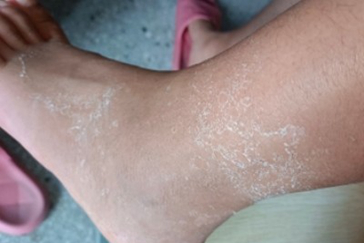 鳞屑角化型足癣脚背脱屑图 鳞屑角化型足癣脚背脱屑图