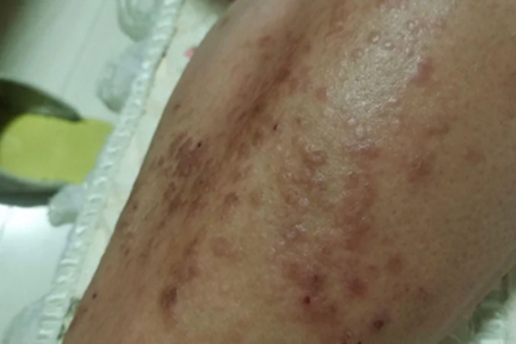 亚急性湿疹小腿血痂图