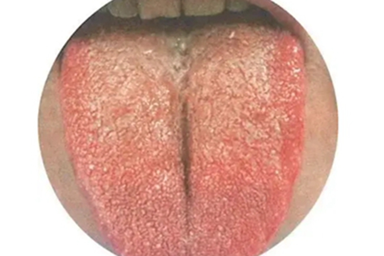 裂纹舌症状图 裂纹舌症状图