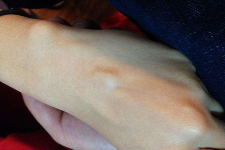 手背脂肪瘤图 手背脂肪瘤图