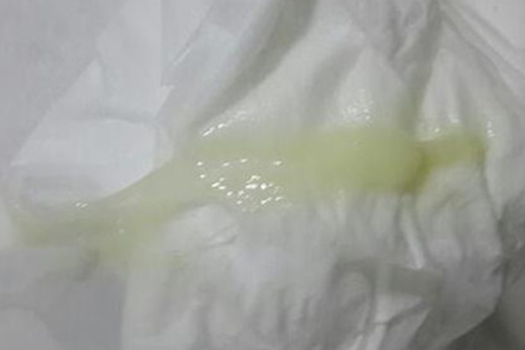 子宫内膜炎黄绿色分泌物图