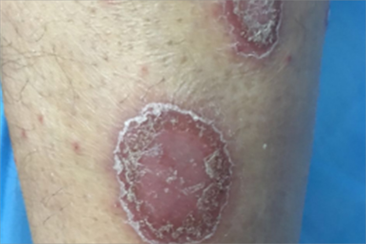 寻常型银屑病症状图