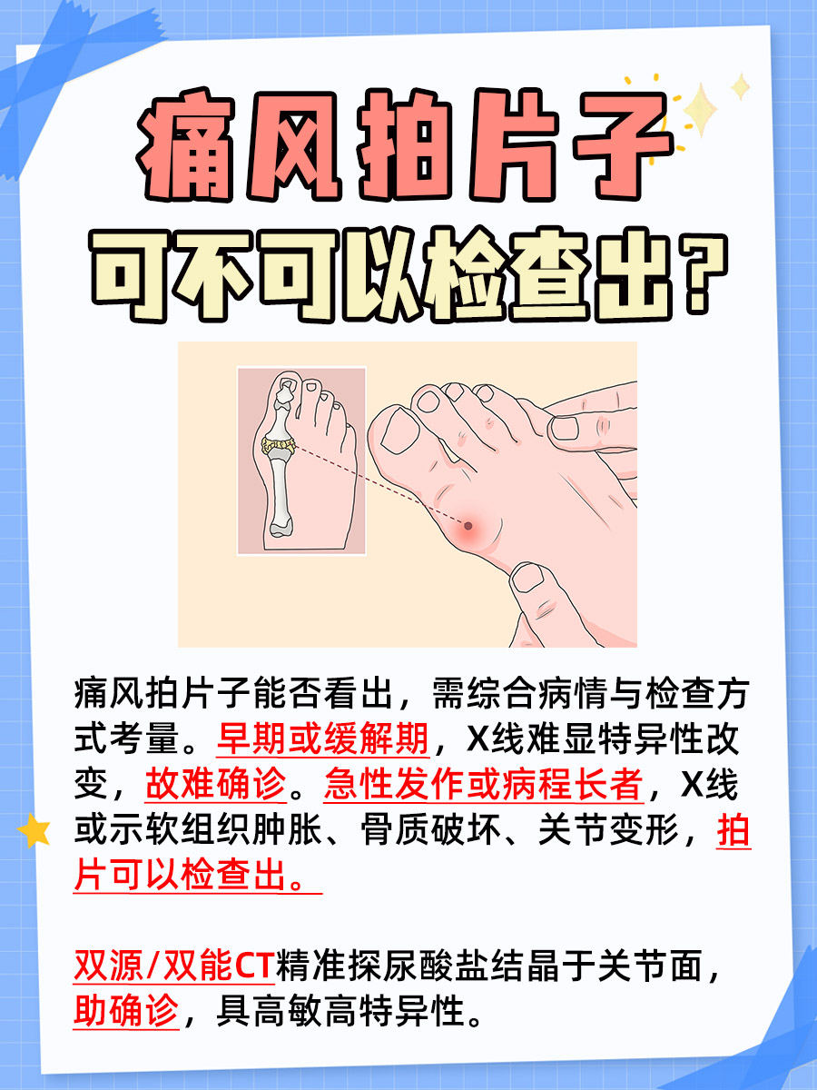 专家告诉你：痛风拍片子看得出来吗？