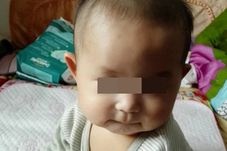 宝宝冠状缝凹陷图