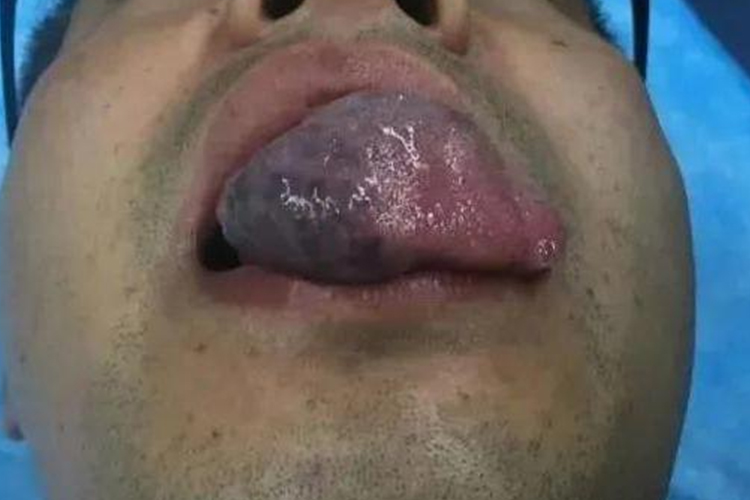 舌下增大血管瘤图