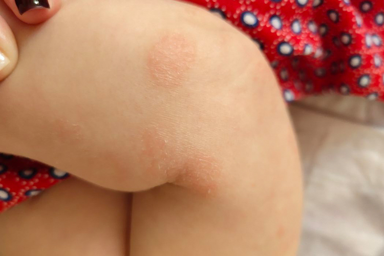 宝宝体癣图