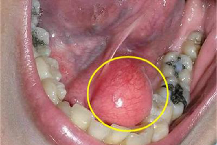 涎腺囊肿口腔包块图