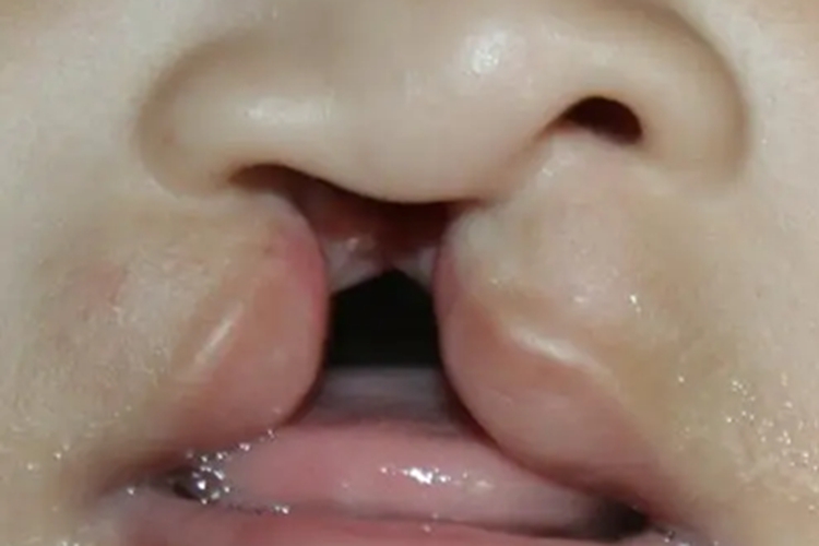 先天性风疹综合征畸形图