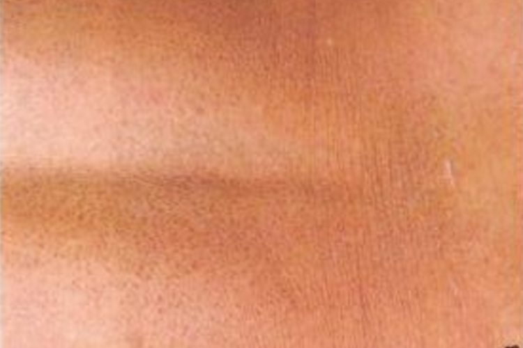 斑状淀粉样变图