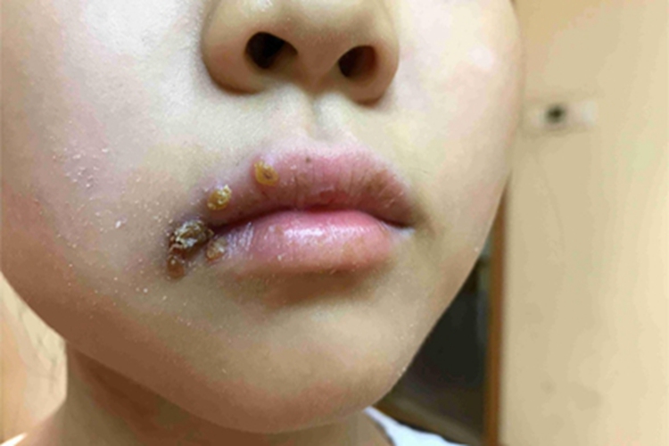 口唇疱疹嘴唇上有很多水疱图