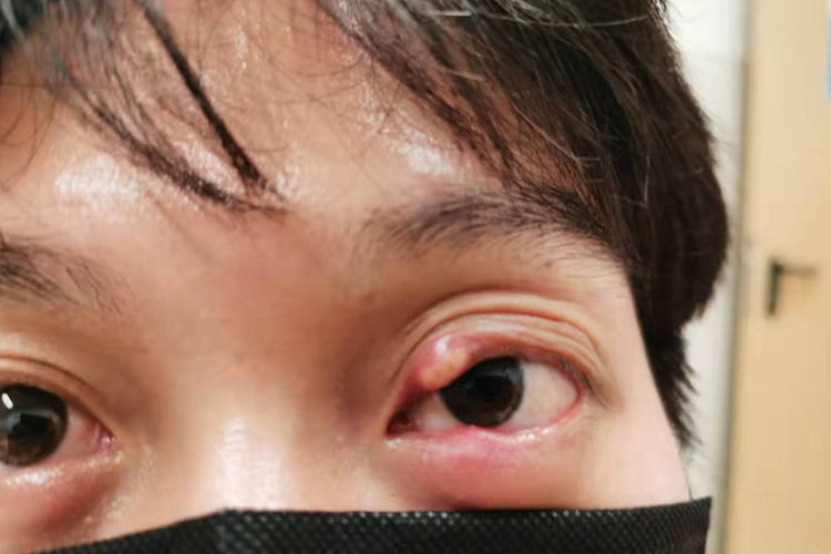 睑腺炎局部红肿硬结图