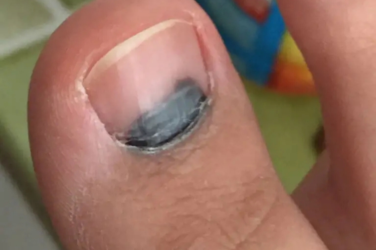 大脚趾头甲下淤血图