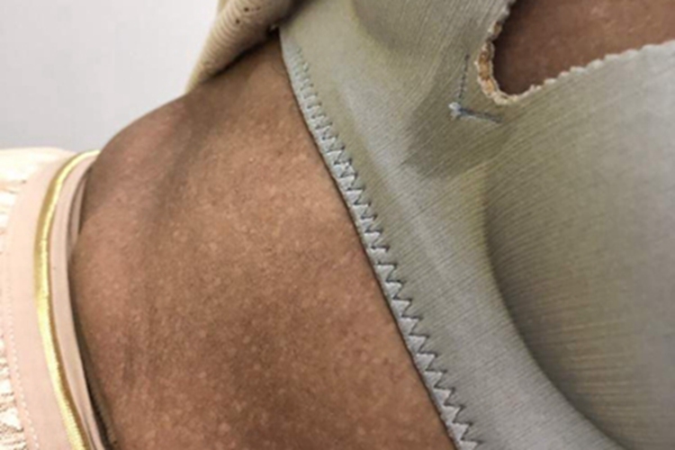 焦油黑变病白点图 焦油黑变病白点图