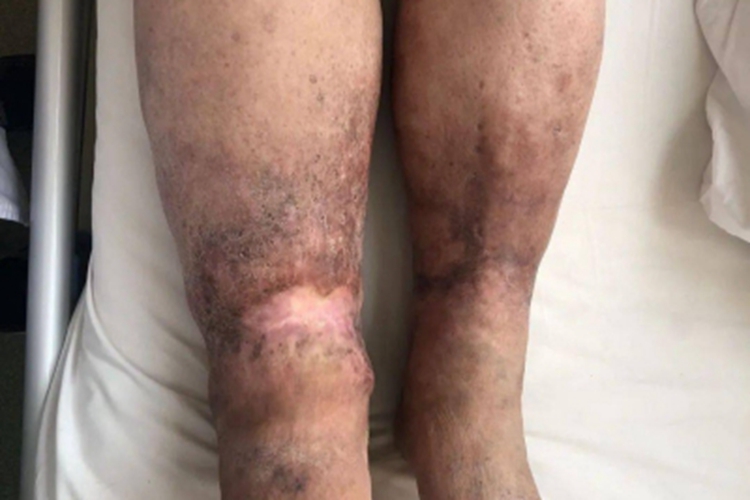 原发性淋巴水肿双侧小腿发黑图
