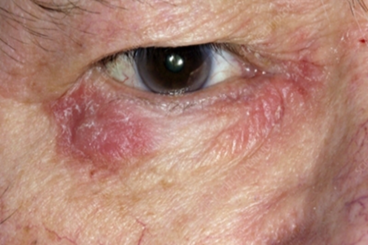 亚急性眼睑湿疹眼睑症状图 亚急性眼睑湿疹眼睑症状图