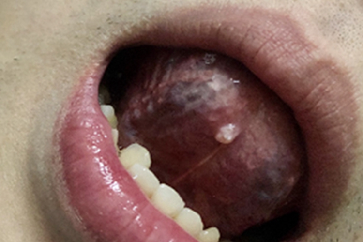 潴留性黏液囊肿舌头小疙瘩图