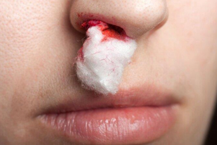 急性白血病鼻腔出血图