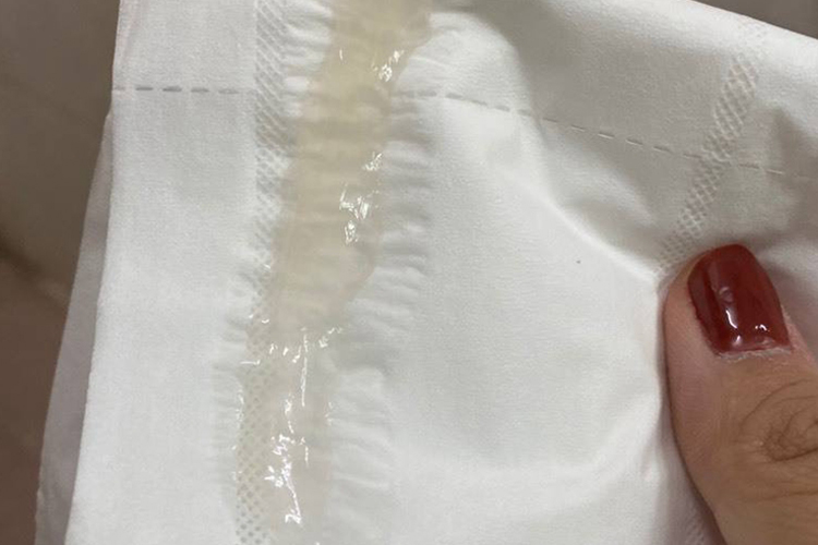 慢性鼻窦炎清涕图