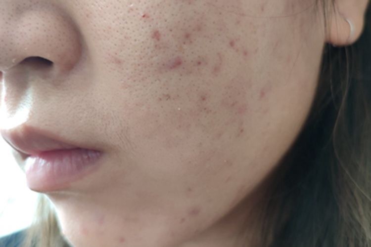 痤疮左脸上长斑点图