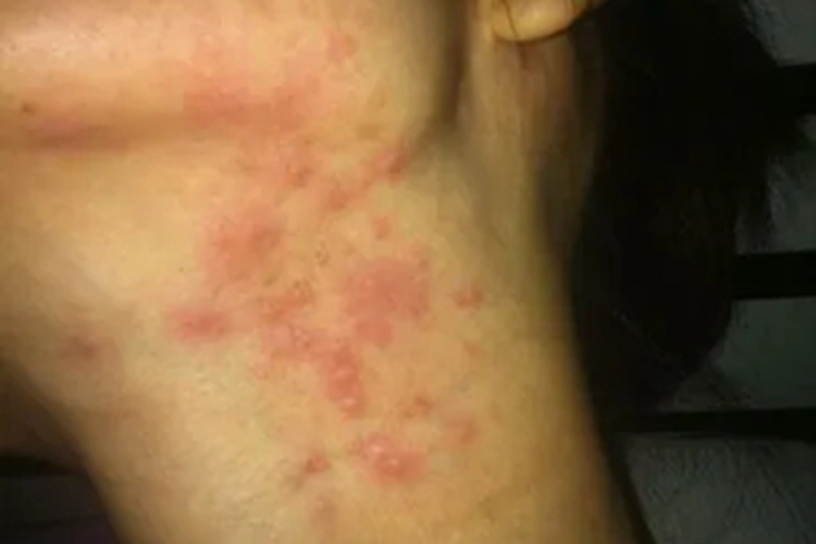 柯萨奇病毒疹颈部症状图