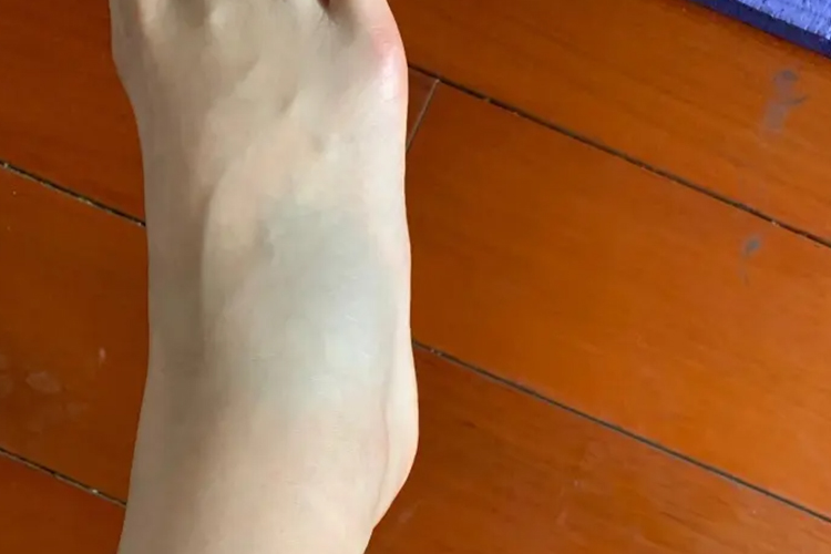 踝关节扭伤肿胀图