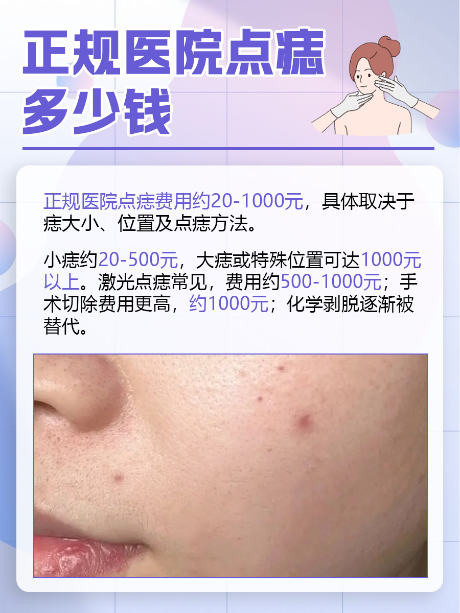 正规医院点痣多少钱？医生专业解答